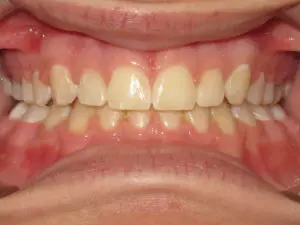 Braces Before and After Pictures in Virginia Beach, VA