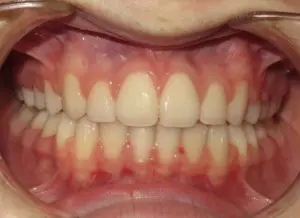 Braces Before and After Pictures in Virginia Beach, VA