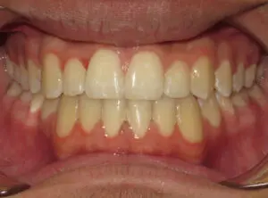 Braces Before and After Pictures in Virginia Beach, VA