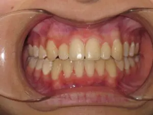 Braces Before and After Pictures in Virginia Beach, VA