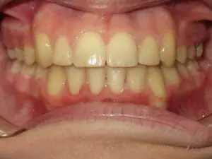 Braces Before and After Pictures in Virginia Beach, VA