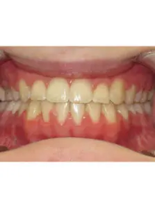 Surgery Before and After Pictures in Virginia Beach, VA