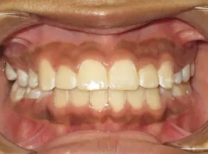 Surgery Before and After Pictures in Virginia Beach, VA