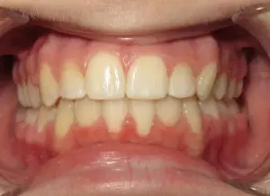 Invisalign Before and After Pictures Virginia Beach, VA
