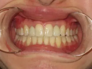 Braces Before and After Pictures in Virginia Beach, VA