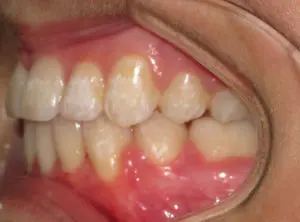 Invisalign Before and After Pictures Virginia Beach, VA