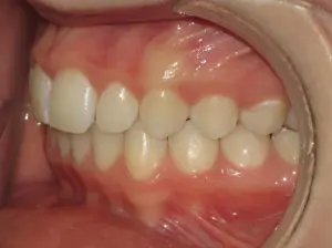 Braces Before and After Pictures in Virginia Beach, VA