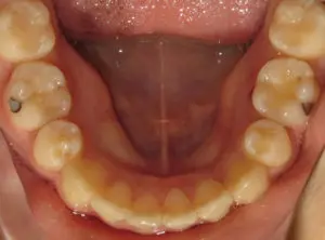 Braces Before and After Pictures in Virginia Beach, VA