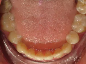 Braces Before and After Pictures Virginia Beach, VA