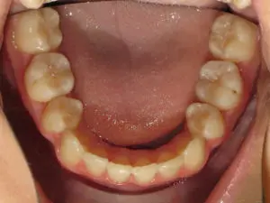 Braces Before and After Pictures in Virginia Beach, VA