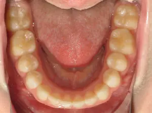 Braces Before and After Pictures in Virginia Beach, VA