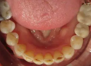 Invisalign Before and After Pictures in Virginia Beach, VA