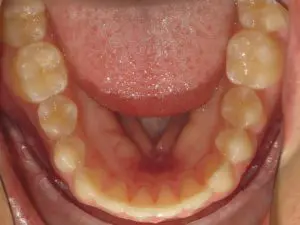 Invisalign Before and After Pictures in Virginia Beach, VA