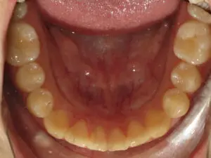 Invisalign Before and After Pictures in Virginia Beach, VA