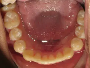 Invisalign Before and After Pictures in Virginia Beach, VA