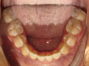 Surgery Before and After Pictures in Virginia Beach, VA