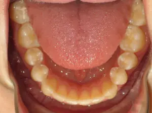 Braces Before and After Pictures in Virginia Beach, VA