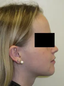 Surgery Before and After Pictures in Virginia Beach, VA