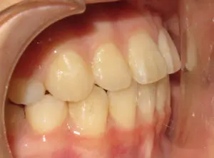 Braces Before and After Pictures in Virginia Beach, VA