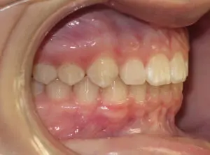 Invisalign Before and After Pictures in Virginia Beach, VA