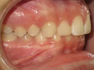 Invisalign Before and After Pictures in Virginia Beach, VA