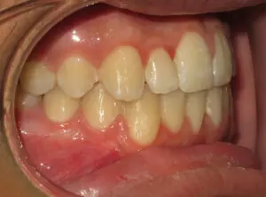 Braces Before and After Pictures in Virginia Beach, VA