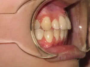 Braces Before and After Pictures in Virginia Beach, VA