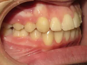 Braces Before and After Pictures in Virginia Beach, VA