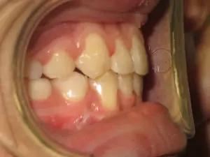 Braces Before and After Pictures Virginia Beach, VA