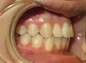 Braces Before and After Pictures Virginia Beach, VA