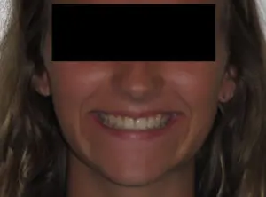 Invisalign Before and After Pictures Virginia Beach, VA