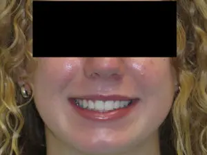 Braces Before and After Pictures in Virginia Beach, VA