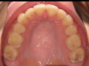 Invisalign Before and After Pictures Virginia Beach, VA