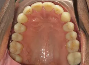 Invisalign Before and After Pictures Virginia Beach, VA