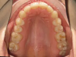 Invisalign Before and After Pictures in Virginia Beach, VA