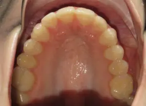 Invisalign Before and After Pictures in Virginia Beach, VA