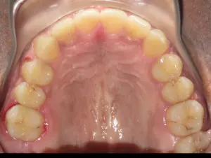 Braces Before and After Pictures in Virginia Beach, VA