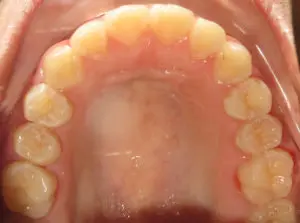 Braces Before and After Pictures Virginia Beach, VA