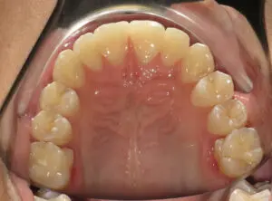 Braces Before and After Pictures in Virginia Beach, VA