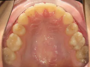 Braces Before and After Pictures Virginia Beach, VA