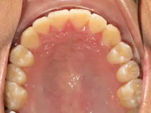 Invisalign Before and After Pictures in Virginia Beach, VA