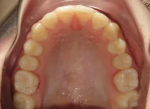 Invisalign Before and After Pictures Virginia Beach, VA