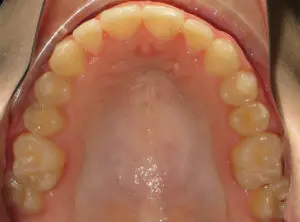 Braces Before and After Pictures Virginia Beach, VA