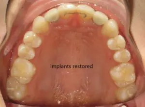 Braces Before and After Pictures in Virginia Beach, VA