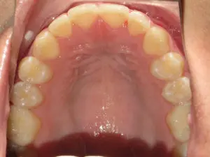 Invisalign Before and After Pictures in Virginia Beach, VA