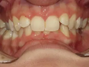 Invisalign Before and After Pictures in Virginia Beach, VA