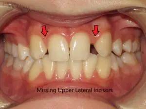 Braces Before and After Pictures in Virginia Beach, VA