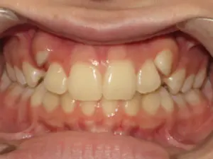 Braces Before and After Pictures in Virginia Beach, VA