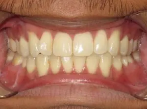 Invisalign Before and After Pictures in Virginia Beach, VA