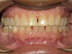 Invisalign Before and After Pictures in Virginia Beach, VA